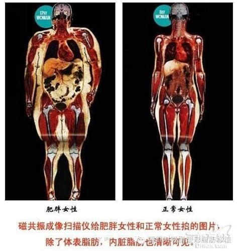抽脂丰胸一般需要多少钱
