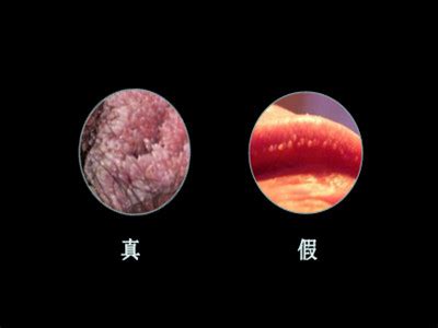 什么是尖锐湿疣?(男性湿锐尖的症状图片)