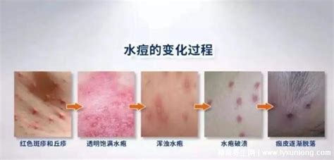 水痘的7天演变过程图片，从红色