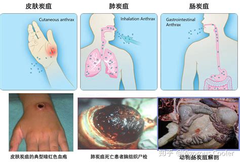 人感染皮肤炭疽病有多可怕,肺炭疽从发病到死亡只有两天(图片)