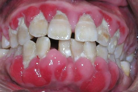 早期牙龈炎图片症状及治疗方法，