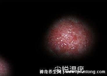 男性尖锐湿尤图初期图片，出现淡