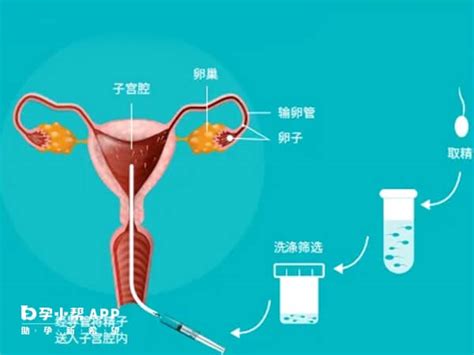 人工授精是怎样操作的图片(人工授精是怎样操作的)