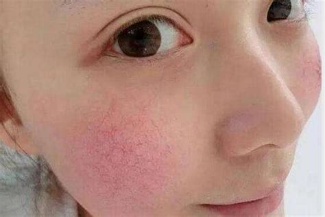 如何去红血丝 6大秘方去除脸上红血丝