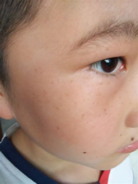 小孩脸上长斑什么原因引起的