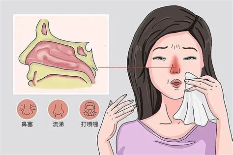 慢性鼻炎怎么治 小偏方治疗慢性鼻炎