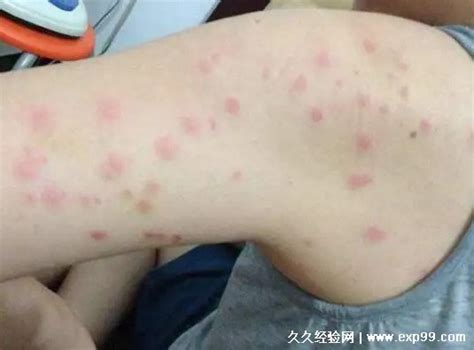 人身上被螨虫叮咬后的症状图,长红疹子奇痒难耐/螨虫最怕这3种