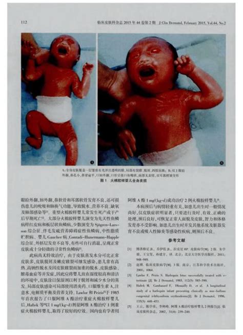 火棉胶婴儿图片,皮肤开裂脱皮似外星人(原图过于恐怖吓人)