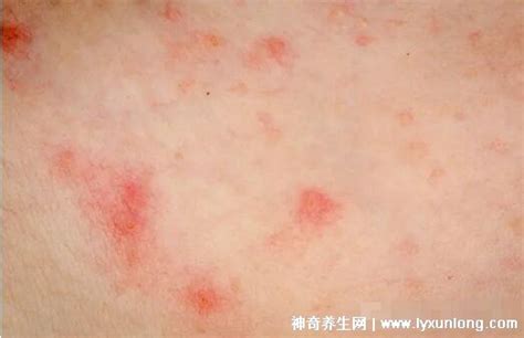18种常见的皮肤病图片对照表,湿疹/荨麻疹/扁平疣/毛囊炎合集